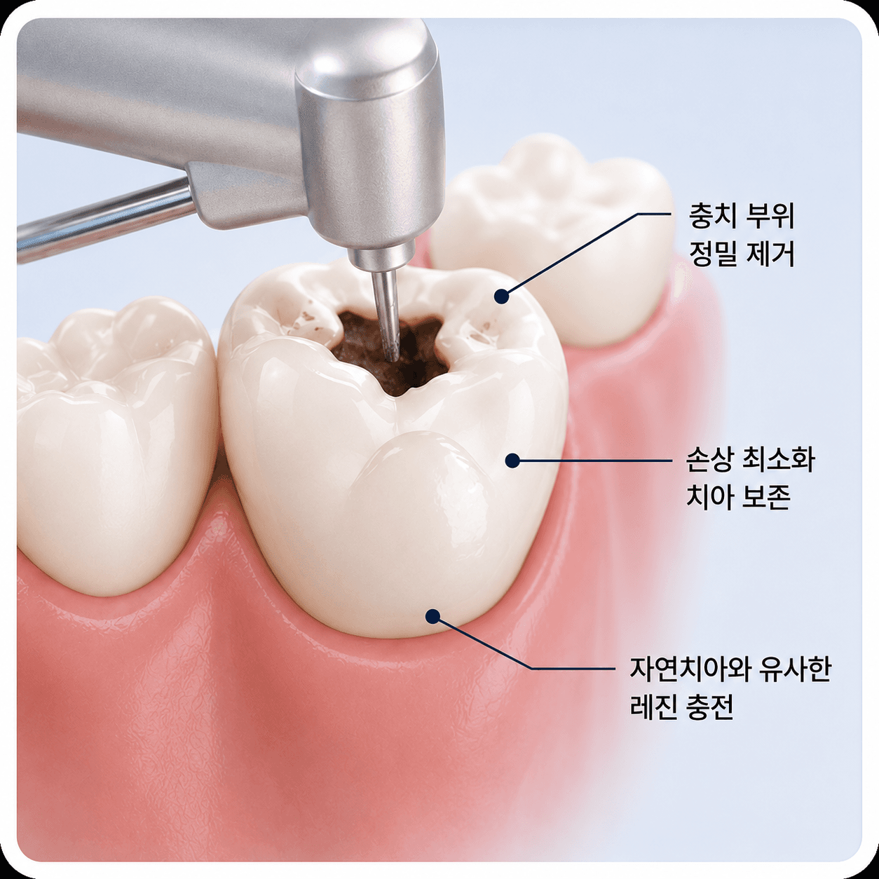 충치치료