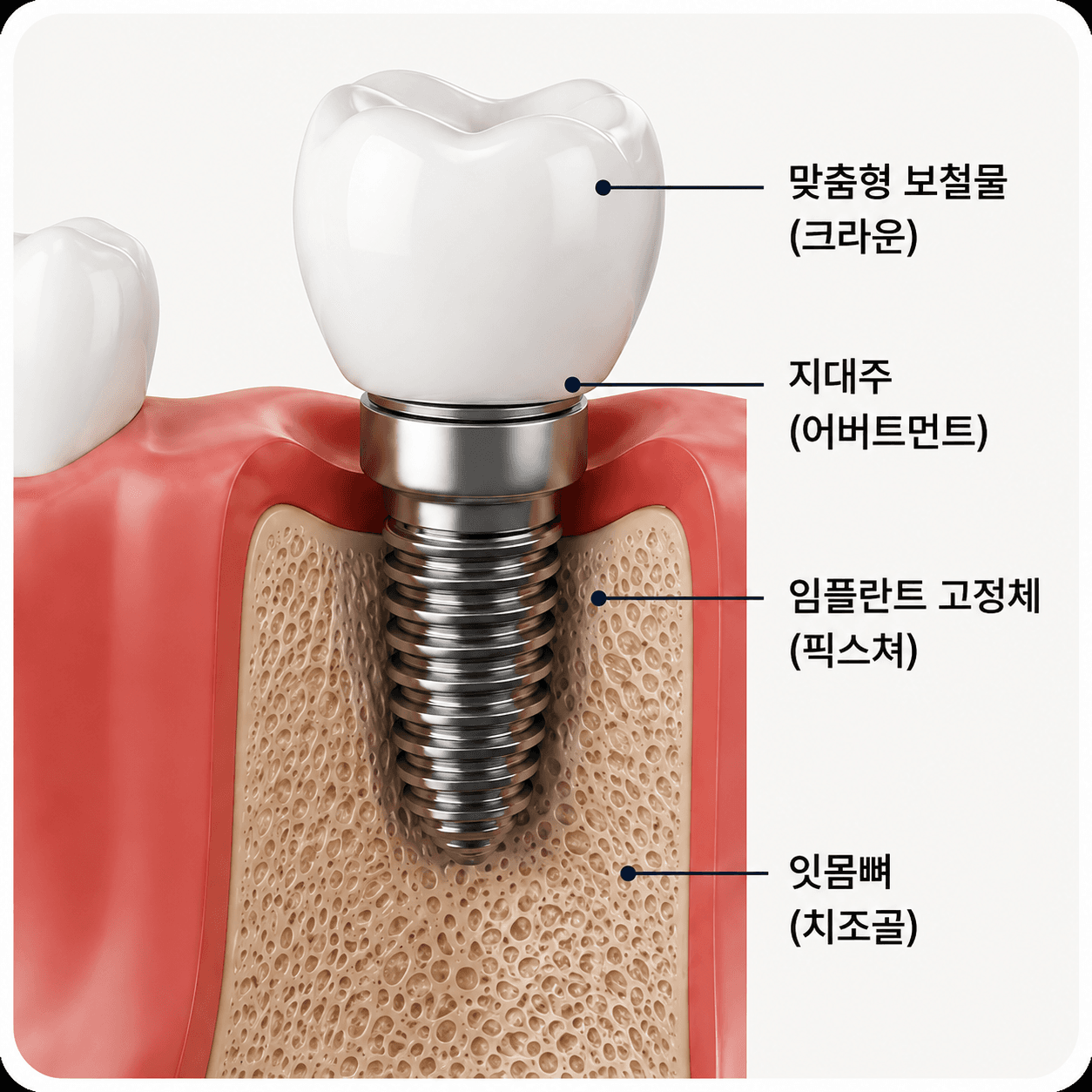 임플란트