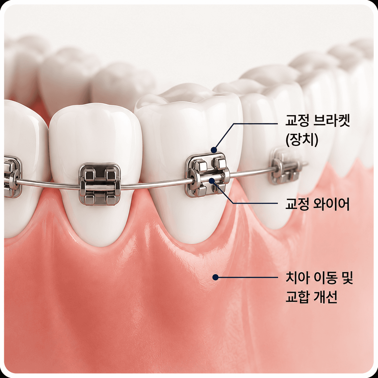 치아교정
