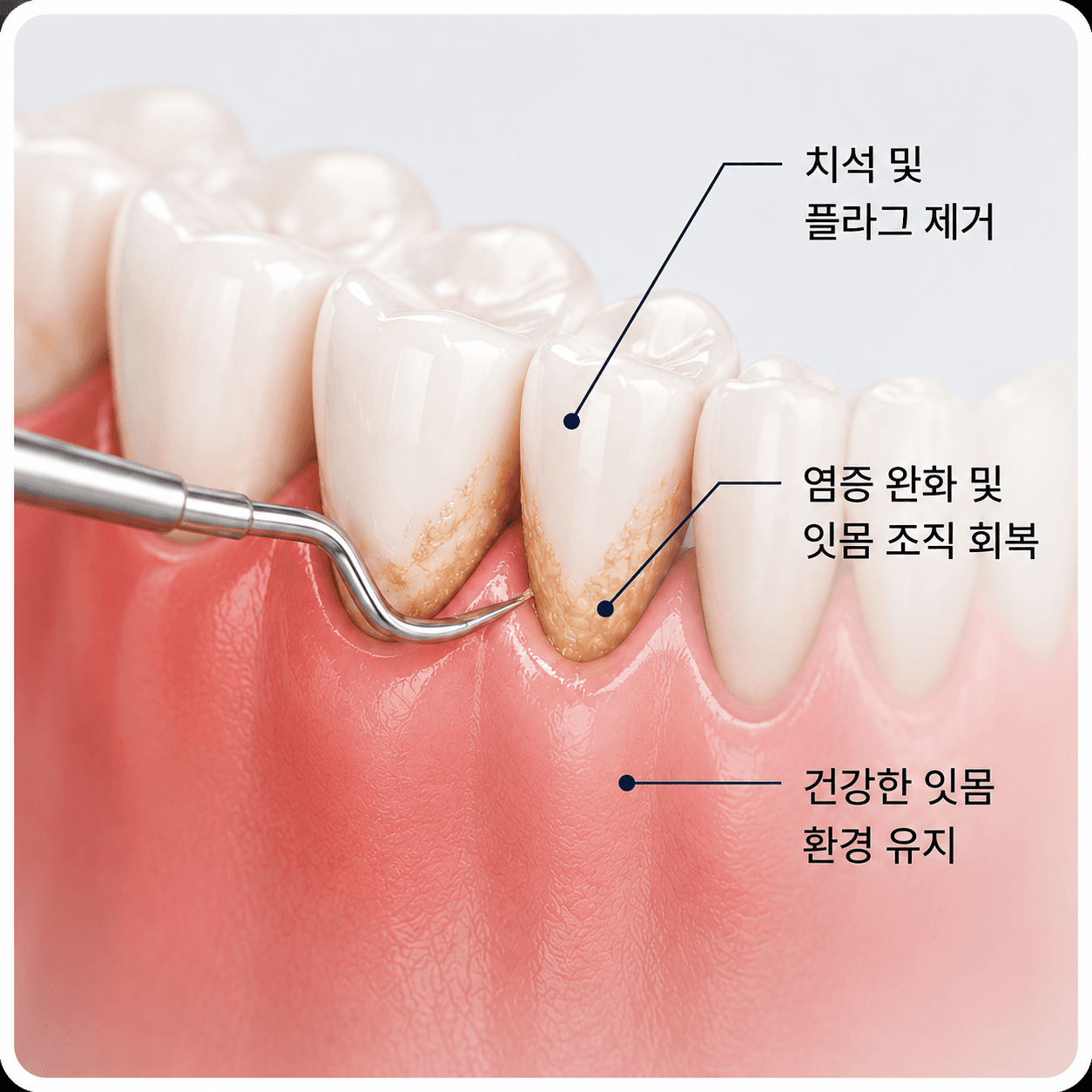 잇몸치료