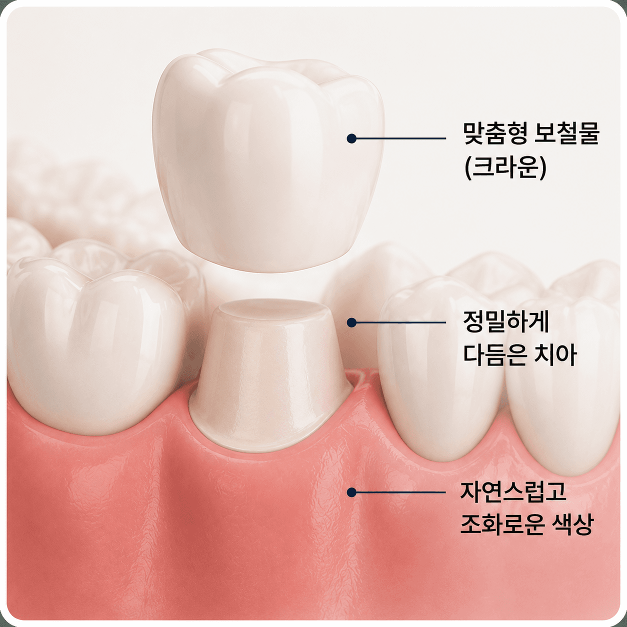심미보철
