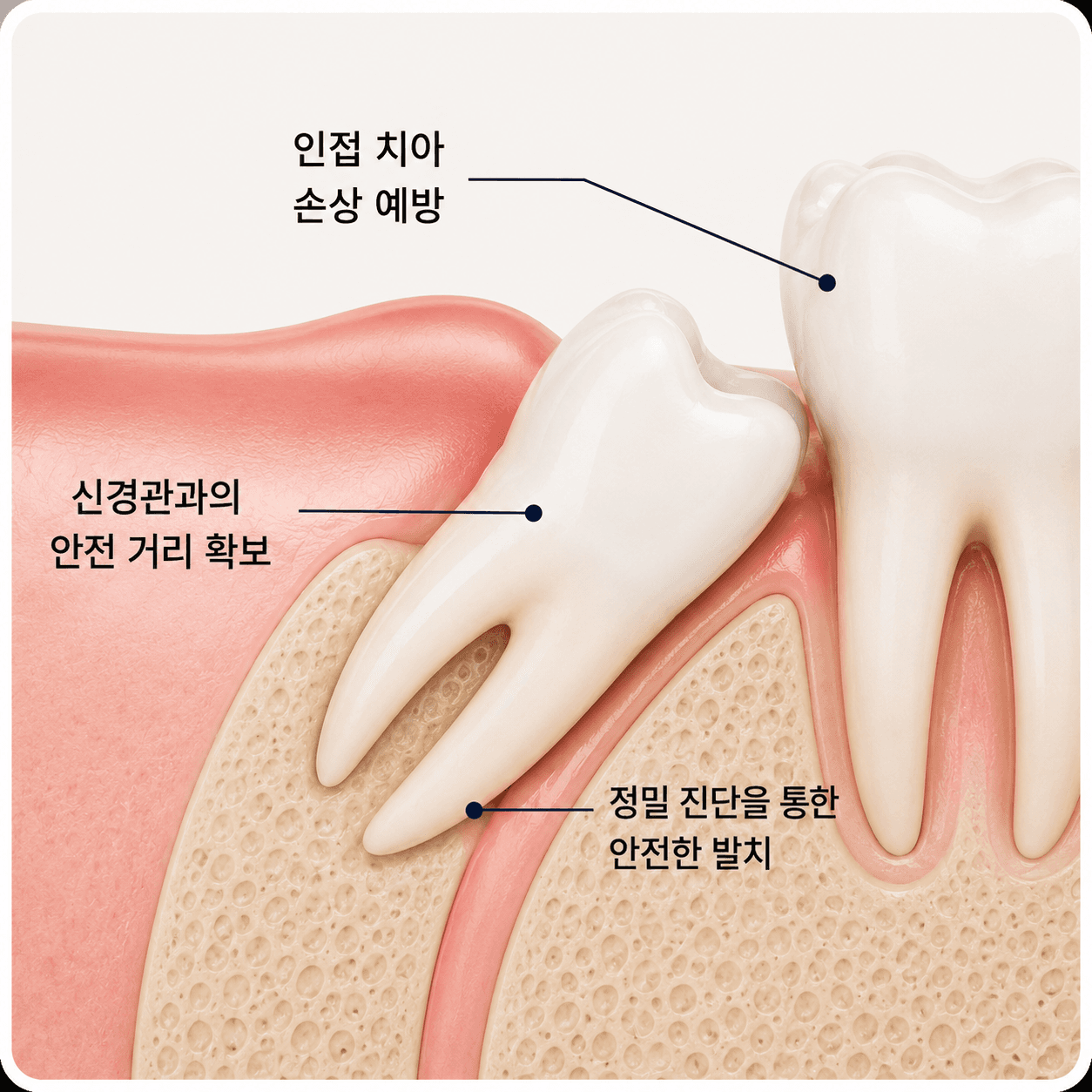 사랑니발치